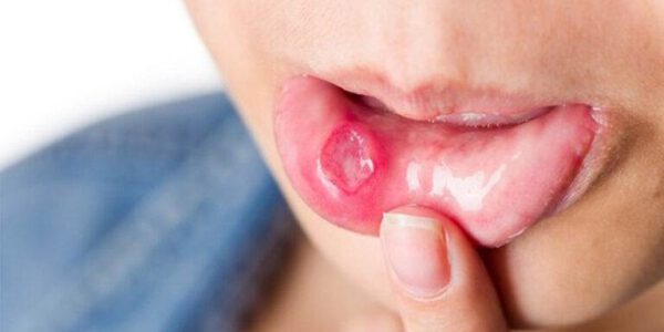 بررسی زخم های دهان توسط متخصص بیماری های دهان فک و صورت