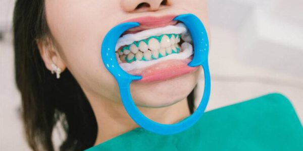 افیس بلیچینگ دندان