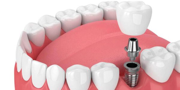 ایمپلنت دندان (کاشت دندان) چیست