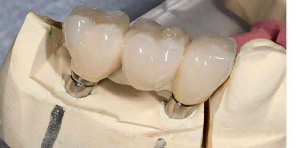 متخصص ایمپلنت دندان در شرق تهران