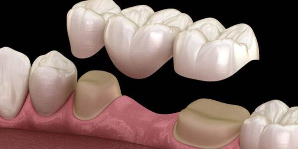 بریج برای جایگزین کردن دندان از دست رفته استفاده می‌شود، با اضافه شدن تاج بر روی ناحیه بی دندانی باعث بهبود ظاهر دندان ها و طرح لبخند می‌شود