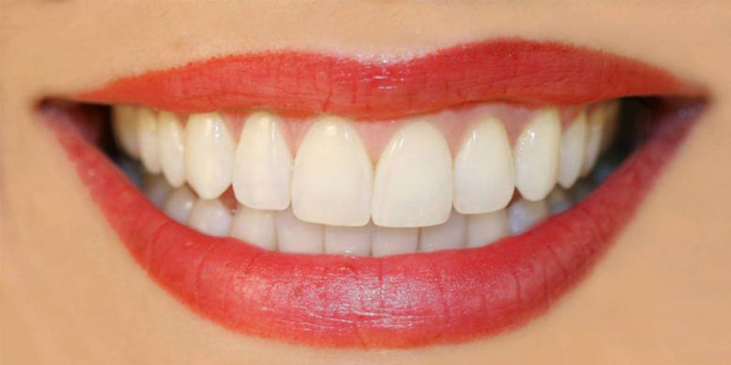 مرتب کردن دندان با روش های مختلف