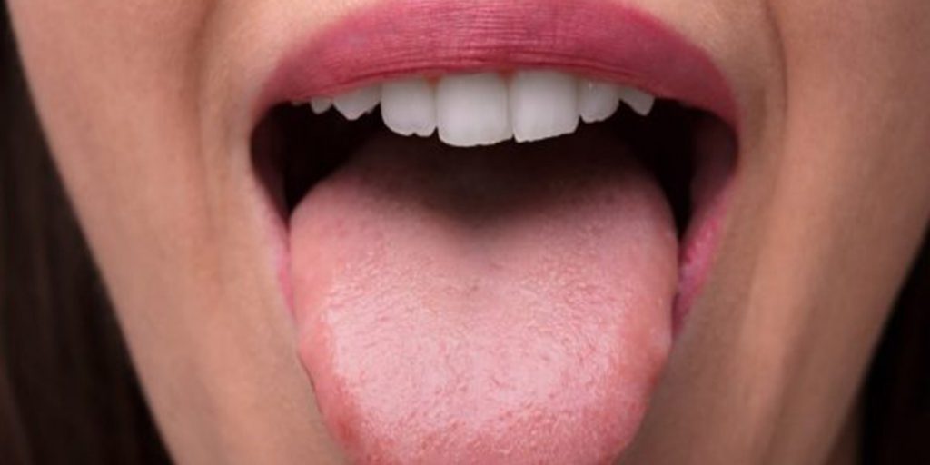 درمان سرطان زبانی