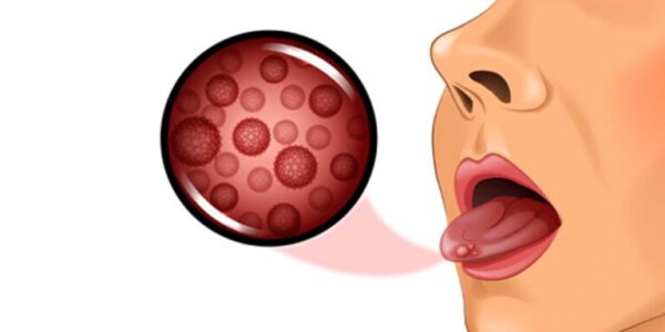 سرطان زبان چیست