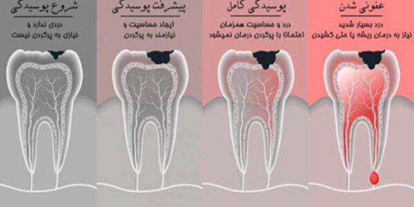 عصب کشی دندان ( درمان ریشه دندان)