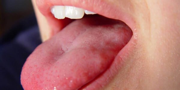 درمان سرطان زبان