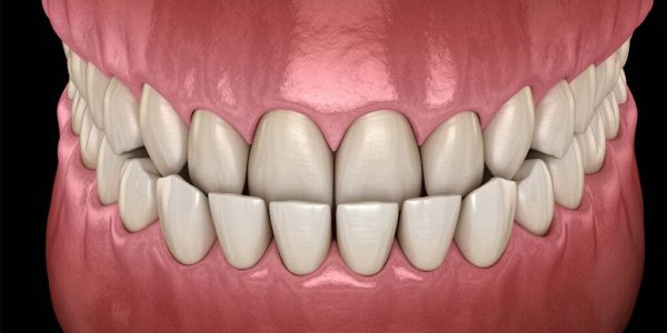 علت به وجود آمدن کراس بایت دندان‌ های قدامی