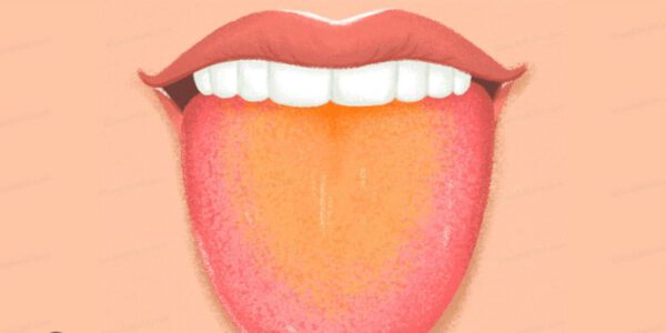 علت سفیدی زبان، تغییر رنگ زبان و احساس سوزش روی زبان