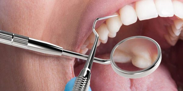 جرم گیری دندان ضرر دارد؟