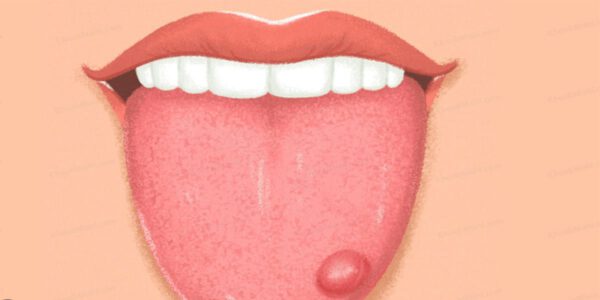 علت سفیدی زبان و لکه های قرمز یا تاول روی زبان