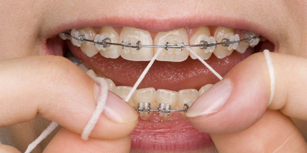 استفاده از نخ دندان ارتودنسی