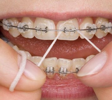 استفاده از نخ دندان ارتودنسی