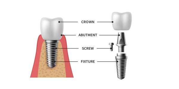 اجزای ایمپلنت دندانی