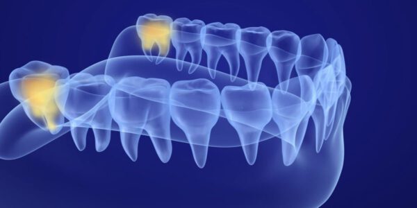 جراحی دندان عقل چگونه است