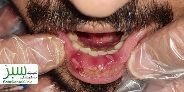 التهاب داخل دهان