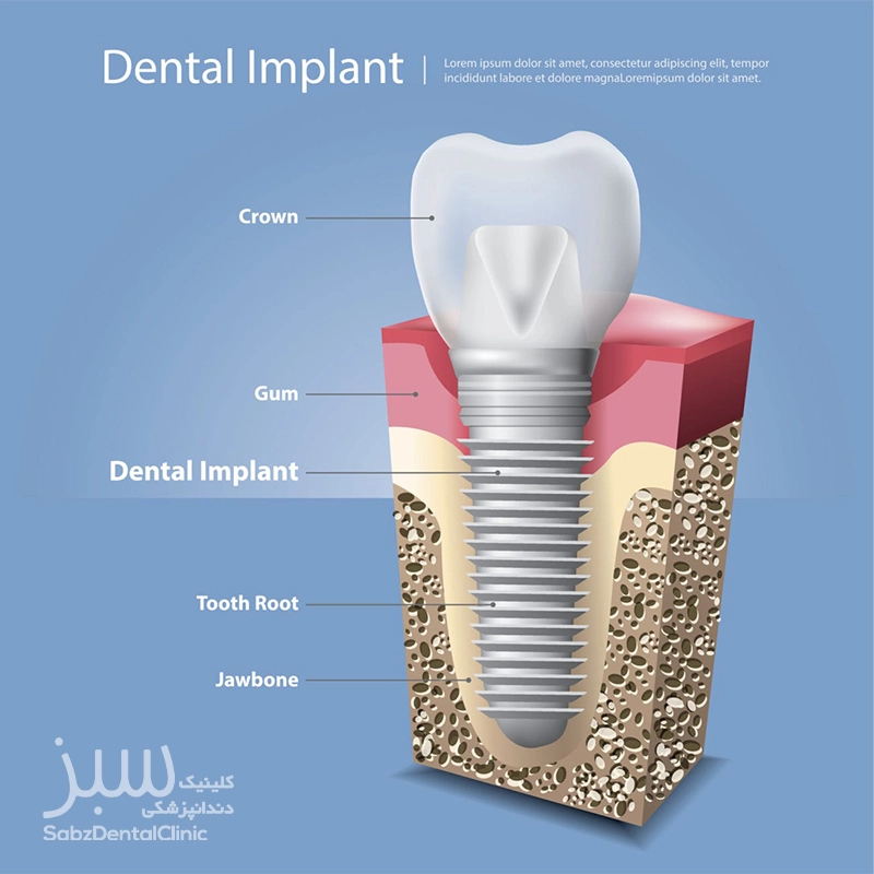طول عمر ایمپلنت دندان