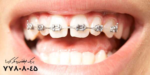 از بین بردن فاصله بین دندان‌ ها با ارتودنسی