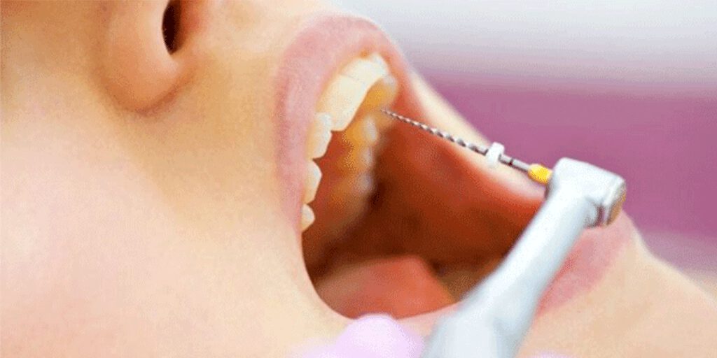 عصب کشی تخصصی دندان جلو