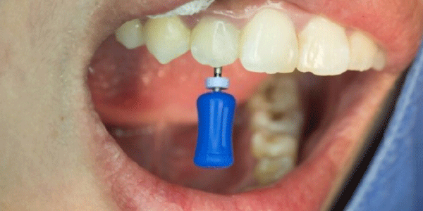 درمان ریشه تخصصی دندان جلو