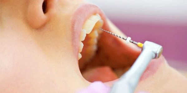درمان ریشه تخصصی دندان