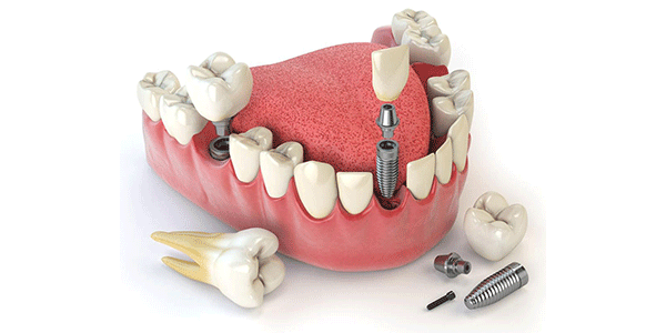 دشمن ایمپلنت دندان در مراقبت های بعد از ایمپلنت