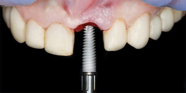ایمپلنت دندانی یک روش مناسب و یک جایگزین دائمی برای دندان های از دست رفته است.