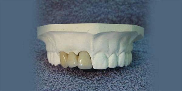 پل دندانی
