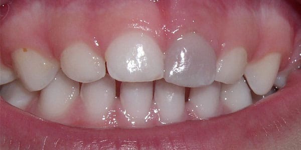 تغییر رنگ دندان کودک از مشکلات دهان و دندان اطفال