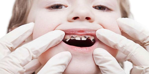پوسیدگی دندان اطفال