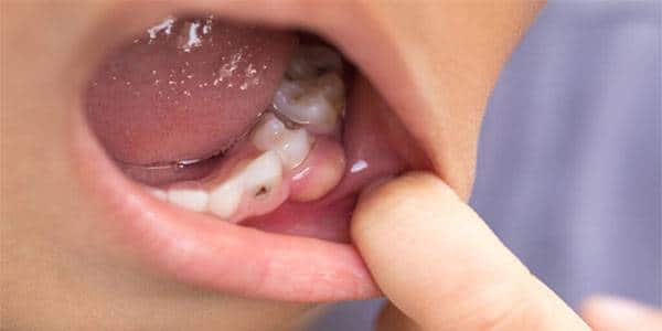 عفونت دندانی
