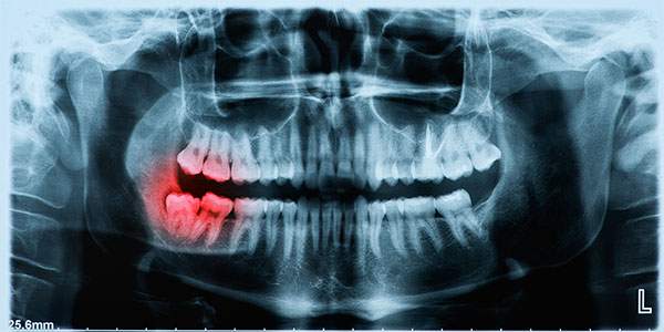 اندو دندان چیست
