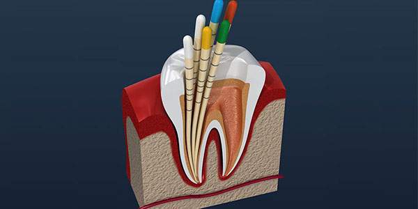فرق درمان ریشه دندان با عصب کشی