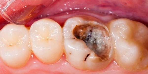 پوسیدگی در دندان
