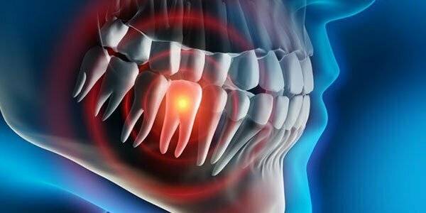 درد بعد از عصب کشی دندان | علت و درمان آن - کلینیک سبز