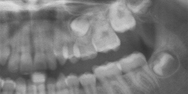 علت تحلیل دندان شیری
