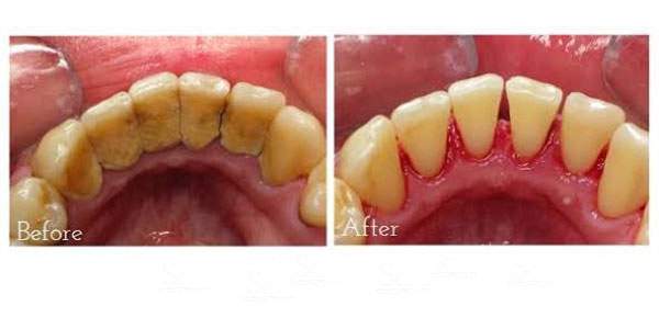 جرمگیری دندان چیست