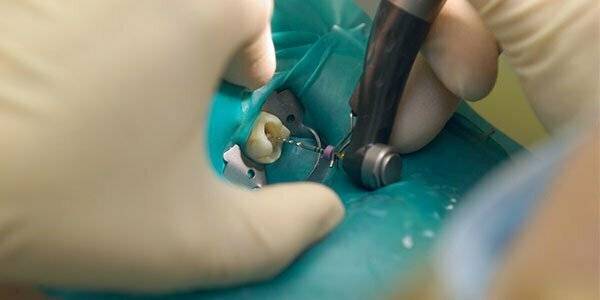 جراحی عفونت ریشه دندان