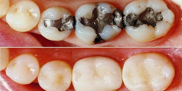 عصب کشی و پر کردن هم زمان دندان