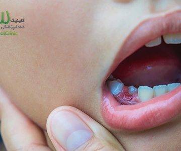افتادن دندان شیری