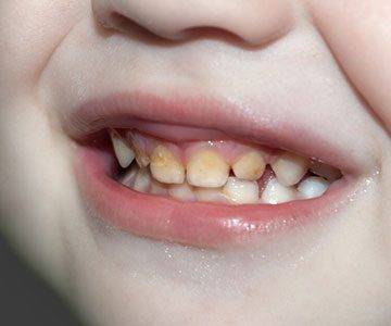 تغییر رنگ دندان در کودکان