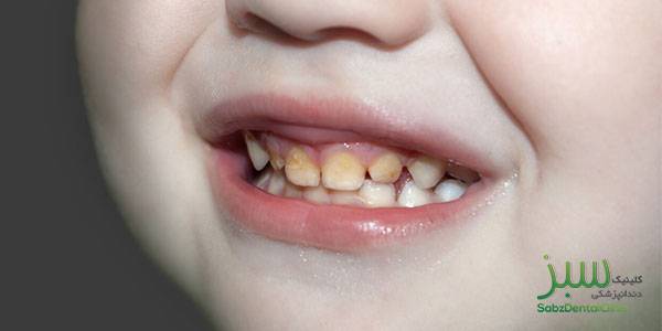 تغییر رنگ دندان در کودکان