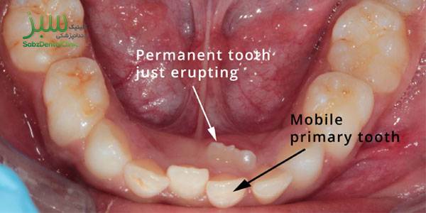 افتادن و درآمدن دندان شیری