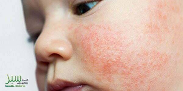 بیماری پوستی پسوریازیس در کودکان