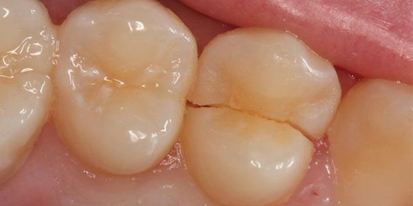 درمان ترک خوردگی دندان