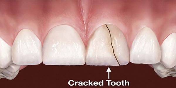 درمان ترک خوردگی دندان