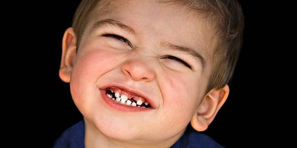 دندان قروچه در کودکان