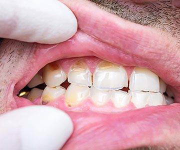 روش های بالا بردن استحکام دندان