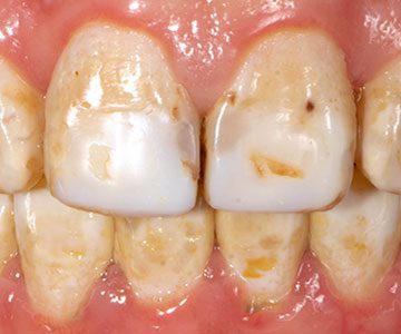 فلوروزیس دندانی چیست