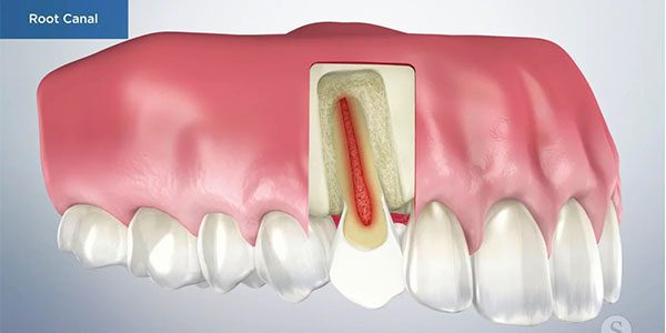 زمان مناسب برای عصب کشی دندان