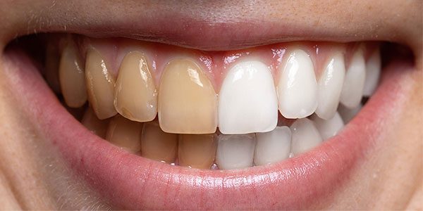روش های سفید کردن دندان